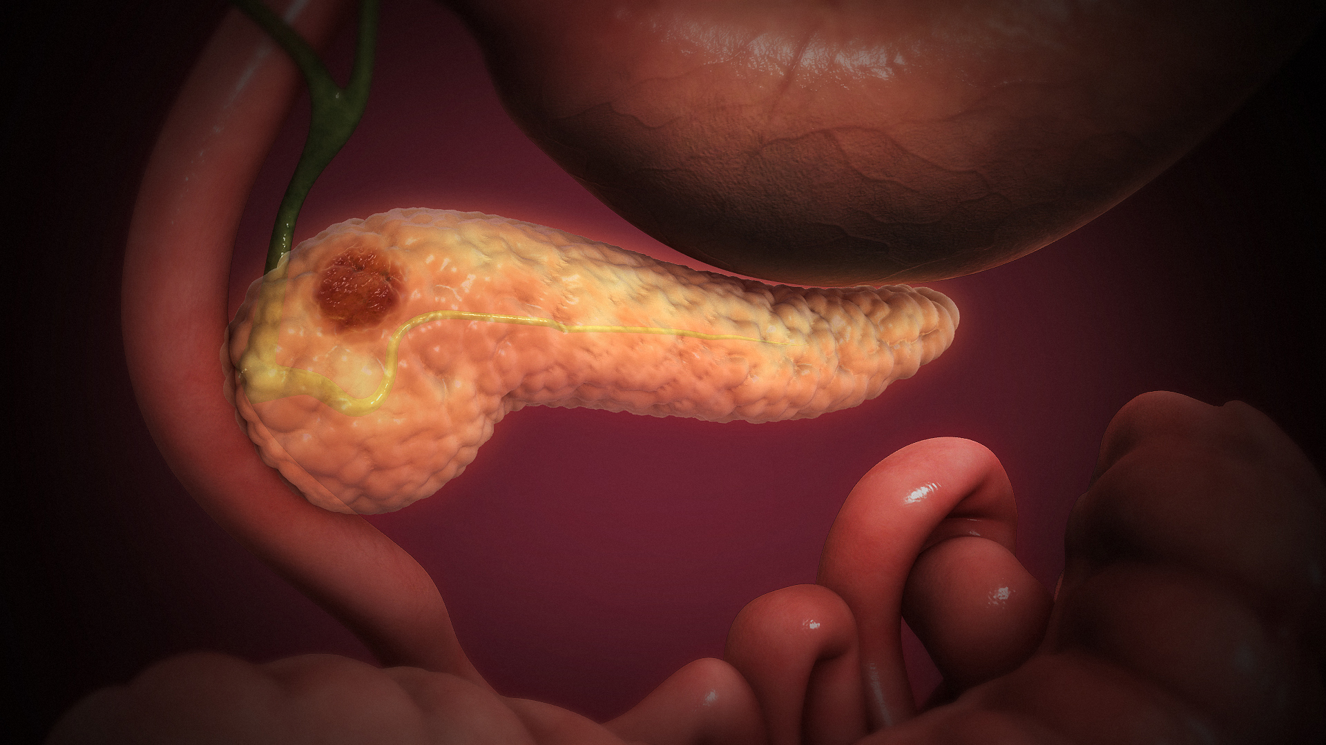 Adenocarcinoma de páncreas, ilustración 3D